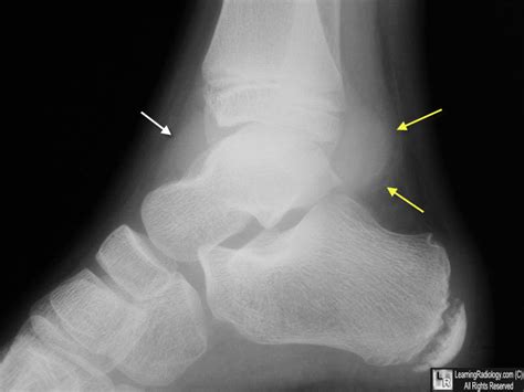 What does <b>small</b> <b>effusion</b> mean? <b>Joint</b> <b>effusion</b> refers to the abnormal accumulation of fluid within the synovial compartment of a <b>joint</b>. . Small tibiotalar joint effusion ankle